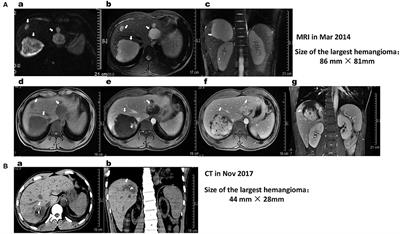 Giant Hepatic Hemangioma Regressed Significantly Without Surgical Management: A Case Report and Literature Review
